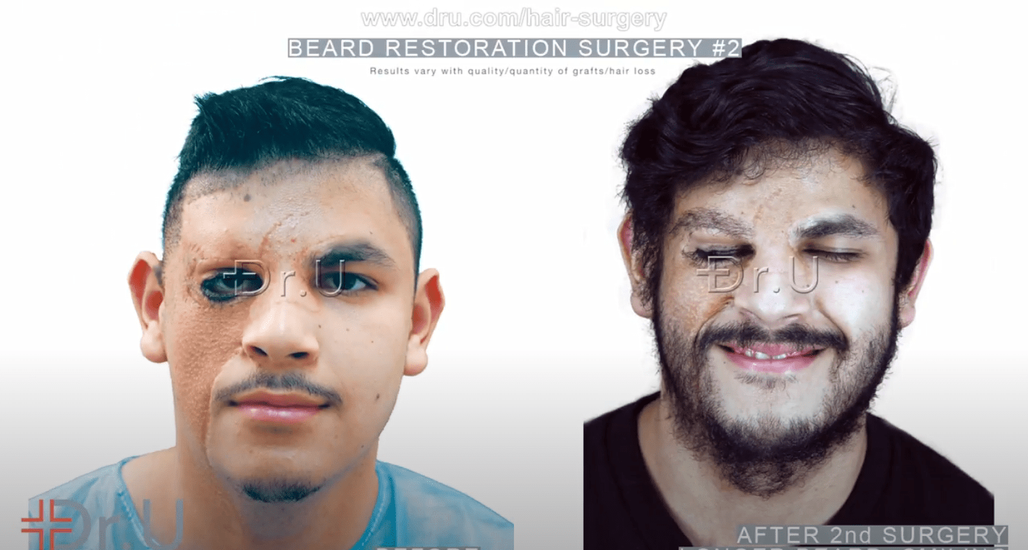 Beard Hair Restoration Surgery Services By Dr.U in Los Angeles