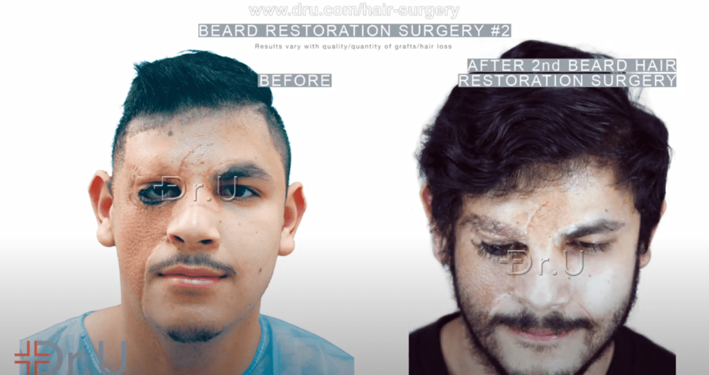Patient's final beard reconstruction results helps camouflage the seams of his skin graft inserted on the right side of his face*