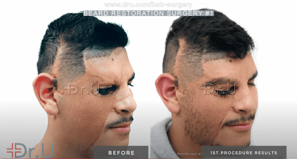Following his first reconstruction procedure with Dr.U, patient now has normal-looking beard growth on the right side of his face 
