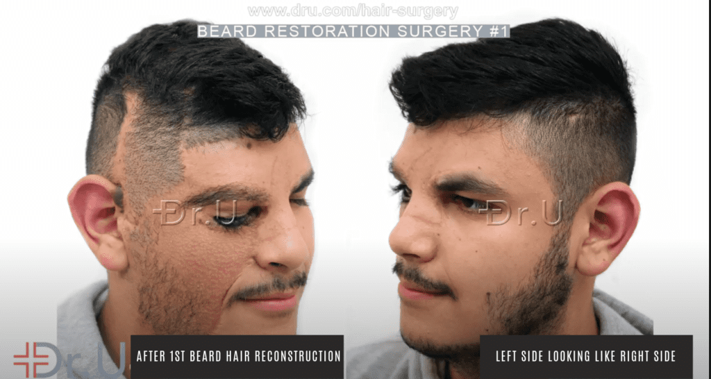 Patient's results following first procedure to recreate the basic beard shape seen on the left side of his face 