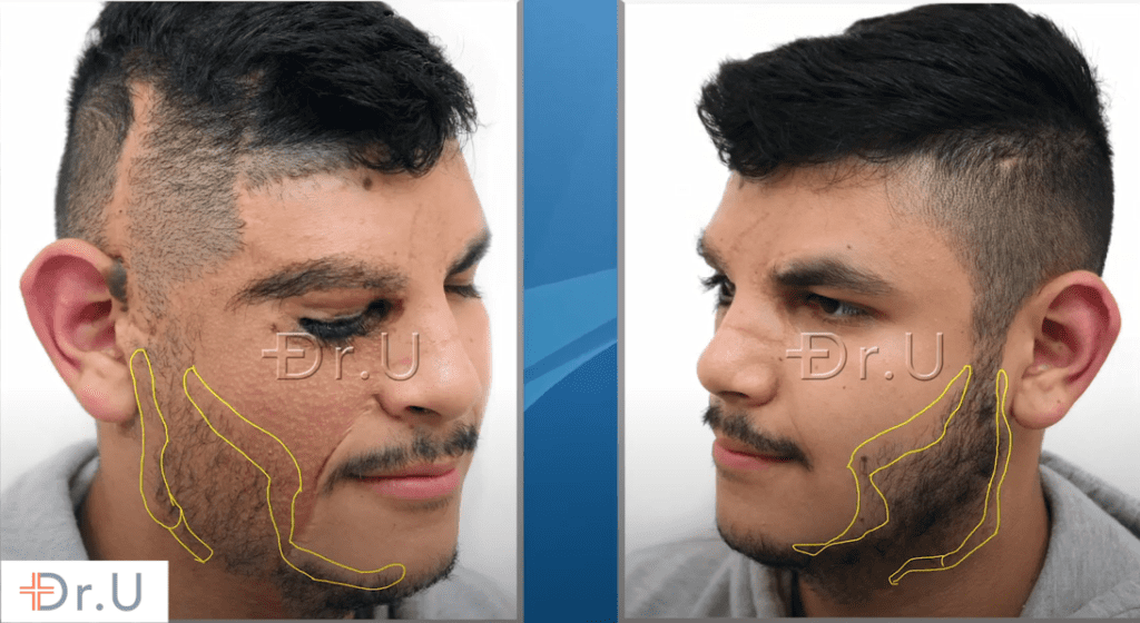 Planning for patient's beard hair restoration outcome, designed by Dr.U