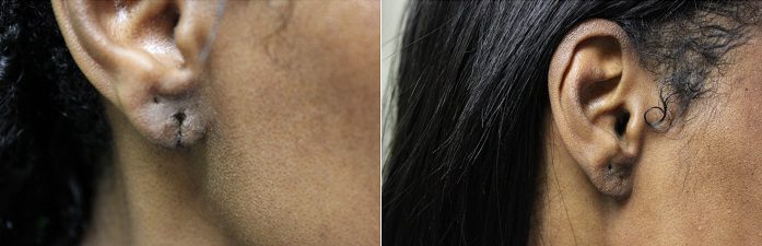 Before and after images of split earlobe repair*