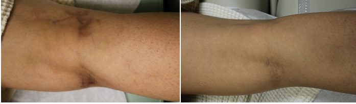 Before and after pictures of leg vein removal procedure with Gentle YAG* Before and after pictures of leg vein removal procedure with Gentle YAG - Dr. U Skin & Hair Clinic