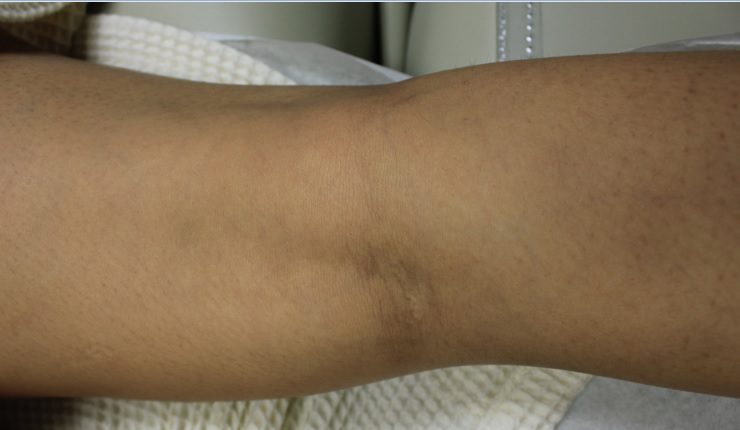 Close up view of leg after the Gentle YAG treatment procedure* Close up view of leg after the Gentle YAG treatment procedure*