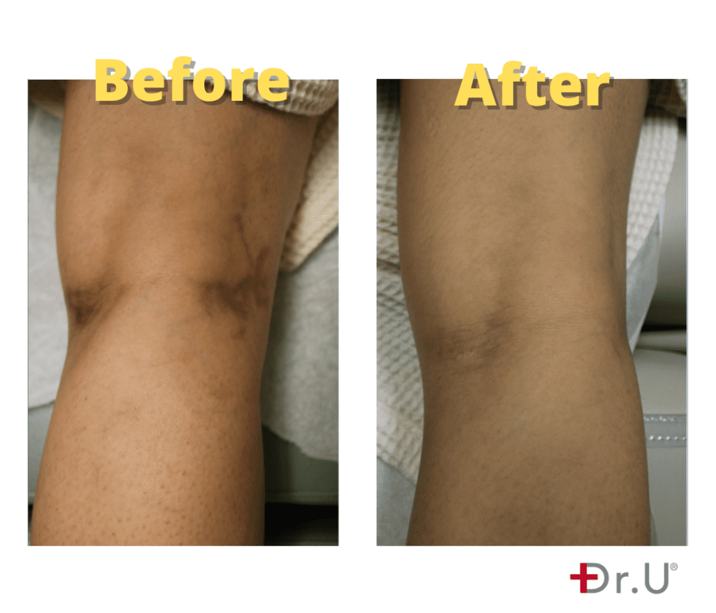 Leg Vein Laser Removal Before & After Results - Dr. U Skin & Hair Clinic, Manhattan Beach, CA* Leg Vein Laser Removal Before & After Results - Dr. U Skin & Hair Clinic, Manhattan Beach, CA*
