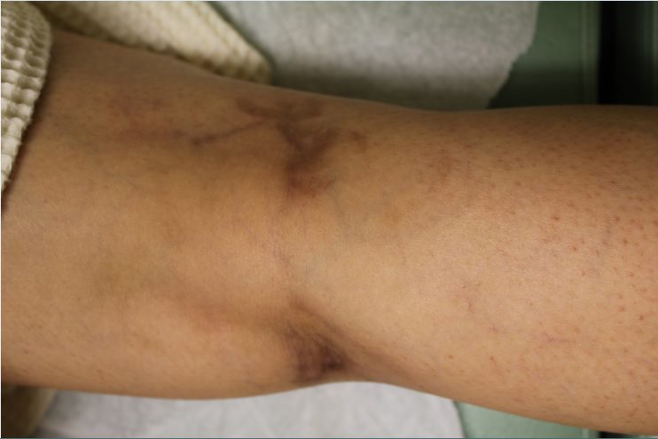 Leg veins prior to removal procedure* Leg veins prior to removal procedure*