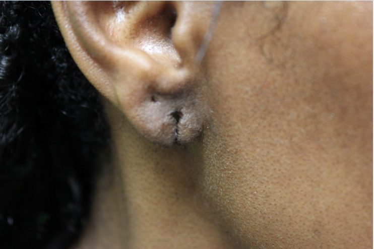 Los Angeles patient's ear before her earlobe reconstruction*