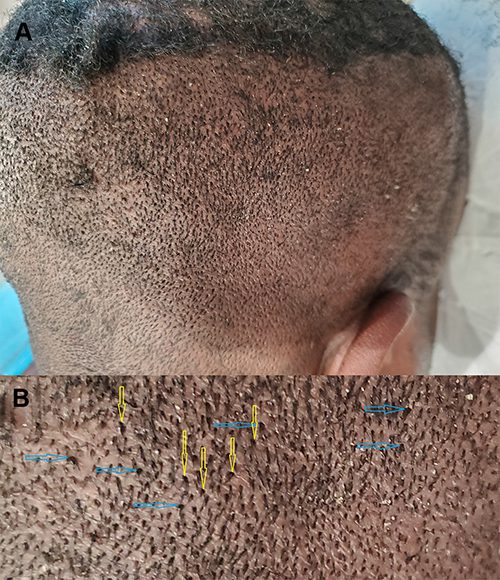 Example of thick/firm scalp. Patient 1 - a male patient of African descent. Right posterior oblique view of the scalp: Thick firm scalp manifesting (A) close-up view showing hair bunching/bouquet hair (yellow arrows), with hooding of hair exit points (blue arrows) (B).* Example of thick/firm scalp. Patient 1 - a male patient of African descent. Right posterior oblique view of the scalp: Thick firm scalp manifesting (A) close-up view showing hair bunching/bouquet hair (yellow arrows), with hooding of hair exit points (blue arrows) (B).*