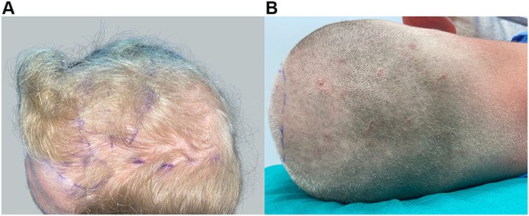Example of soft/thin scalps. Top view of patient 5 (man of North European descent) possessing soft/thin scalp, showing fine hair (A). Posterior view of patient 5, after shaving in preparation for FUE, manifesting high hair density (B).* Example of soft/thin scalps. Top view of patient 5 (man of North European descent) possessing soft/thin scalp, showing fine hair (A). Posterior view of patient 5, after shaving in preparation for FUE, manifesting high hair density (B).*