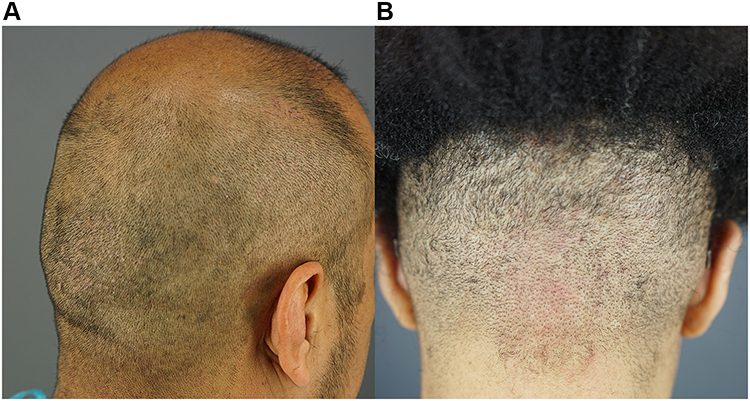 Examples of medium thickness/firmness scalps. Right posterior oblique view of patient 6 (Hispanic man) with medium scalp thickness/firmness (A). Posterior view of patient 8 (woman of African descent) with medium scalp thickness/firmness and curly hair (B).* Examples of medium thickness/firmness scalps. Right posterior oblique view of patient 6 (Hispanic man) with medium scalp thickness/firmness (A). Posterior view of patient 8 (woman of African descent) with medium scalp thickness/firmness and curly hair (B).*