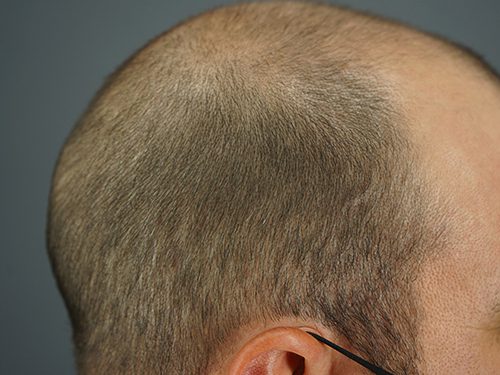 an FUE patient with straight hair * an FUE patient with straight hair *