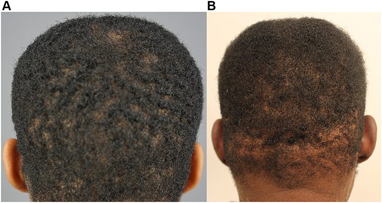 Posterior views of the scalps of patient 11 (A) and patient 2 (B) before shaving showing types 4a–b and 4c hair types, respectively.* Posterior views of the scalps of patient 11 (A) and patient 2 (B) before shaving showing types 4a–b and 4c hair types, respectively.*