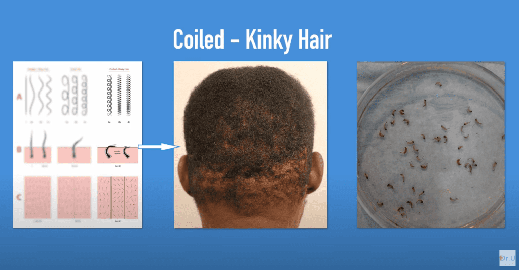 On the left, a drawing showing long coily hair shafts, the subcutaneous shape of coily follicular units, and appearance from the surface after shaving to 2–3 mm. In the middle, a patient with coily hair. On the far right, grafts taken from a coily-haired patient.* On the left, a drawing showing long coily hair shafts, the subcutaneous shape of coily follicular units, and appearance from the surface after shaving to 2–3 mm. In the middle, a patient with coily hair. On the far right, grafts taken from a coily-haired patient.*