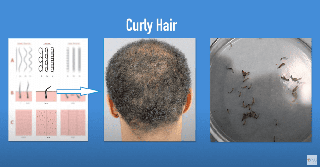 On the left, a drawing showing long curly hair shafts, the subcutaneous shape of curly follicular units, and appearance from the surface after shaving to 2–3 mm. In the middle, a patient with curly hair. On the far right, grafts taken from a curly-haired patient.* On the left, a drawing showing long curly hair shafts, the subcutaneous shape of curly follicular units, and appearance from the surface after shaving to 2–3 mm. In the middle, a patient with curly hair. On the far right, grafts taken from a curly-haired patient.*