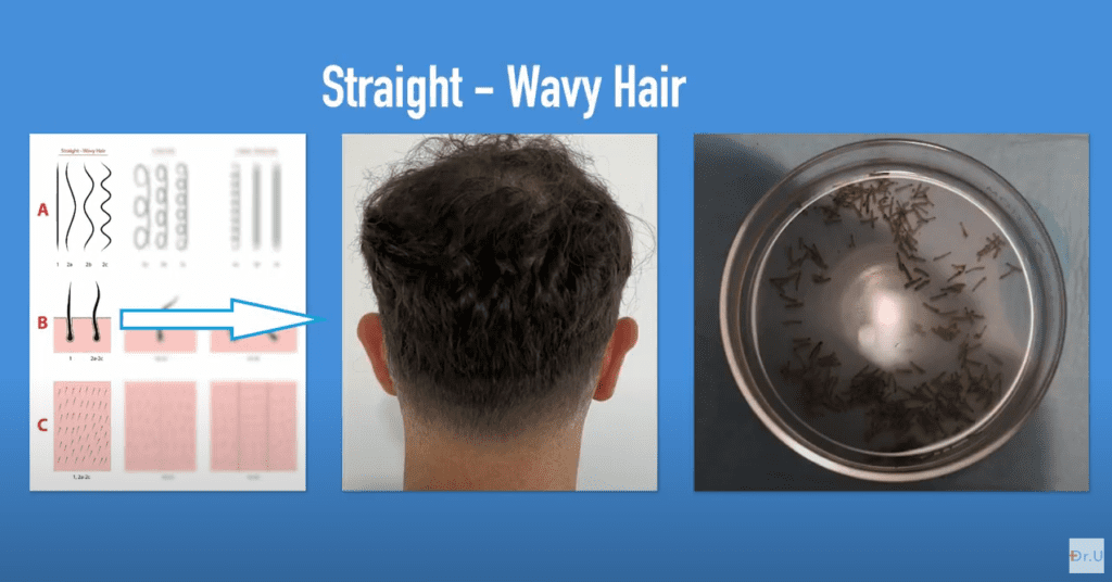 On the left, a drawing showing long straight-wavy hair shafts, the subcutaneous shape of straight follicular units, and appearance from the surface after shaving to 2–3 mm. In the middle, a patient with straight-wavy hair. On the far right, grafts taken from a straight - wavy haired patient.* On the left, a drawing showing long straight-wavy hair shafts, the subcutaneous shape of straight follicular units, and appearance from the surface after shaving to 2–3 mm. In the middle, a patient with straight-wavy hair. On the far right, grafts taken from a straight - wavy haired patient.*