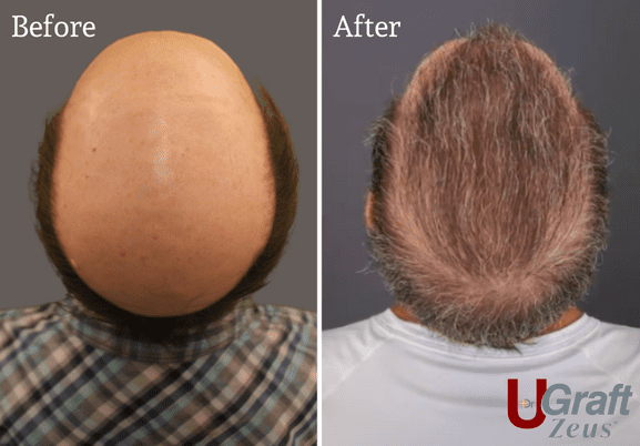 Norwood 8 patient hair transplant results. * Norwood 8 patient hair transplant results. *