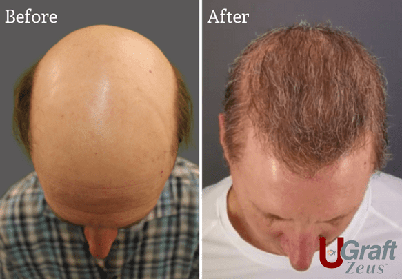Norwood 8 patient hair transplant results. * Norwood 8 patient hair transplant results. *