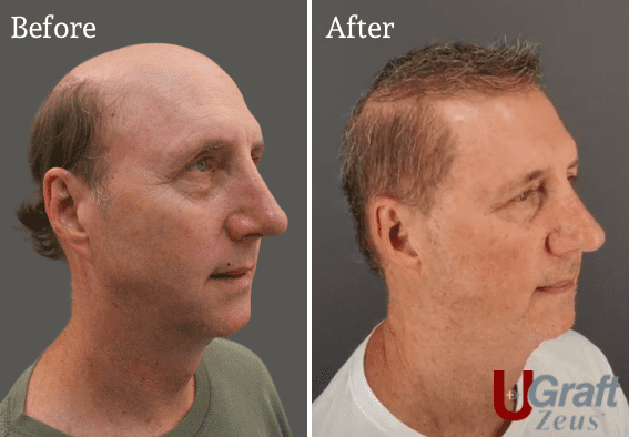 This Norwood 8 patient was able to achieve full coverage by using his body hair. This was made possible with the advanced technology of the UGraft Zeus. * This Norwood 8 patient was able to achieve full coverage by using his body hair. This was made possible with the advanced technology of the UGraft Zeus. *