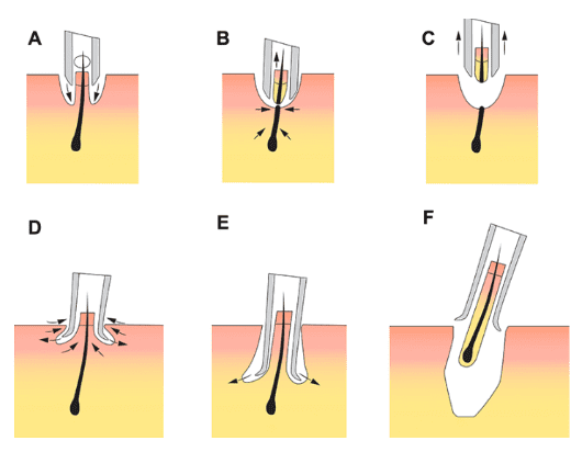 Figure 2 Patent application schematics demonstrating the advantage of a flared punch cutting tip. (A) Outer beveled punch tip shows cutting vectors directed towards the follicle; (B and C) the outer beveled punch transects the follicle before advancing to the follicle’s level (D) a flared punch with cutting vectors pointing away from the follicle (E and F) show minimal tendency to transect grafts while reaching deeper levels of the follicle, unlike the outer beveled punch. Figure 2 Patent application schematics demonstrating the advantage of a flared punch cutting tip. (A) Outer beveled punch tip shows cutting vectors directed towards the follicle; (B and C) the outer beveled punch transects the follicle before advancing to the follicle’s level (D) a flared punch with cutting vectors pointing away from the follicle (E and F) show minimal tendency to transect grafts while reaching deeper levels of the follicle, unlike the outer beveled punch.