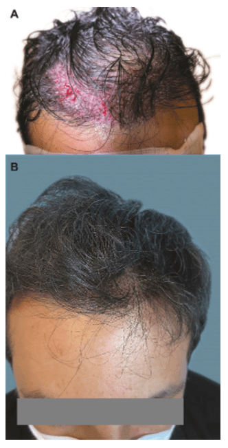 Figure 5 (A) Frontal scalp soon after grafting; and (B) frontal area with minor signs of surgery at 48 h after long-hair implantation. Figure 5 (A) Frontal scalp soon after grafting; and (B) frontal area with minor signs of surgery at 48 h after long-hair implantation.
