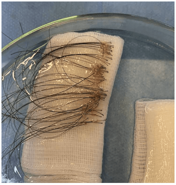 Figure 6 Long-hair grafts drafted by the Ugraft Zeus. Figure 6 Long-hair grafts drafted by the Ugraft Zeus.