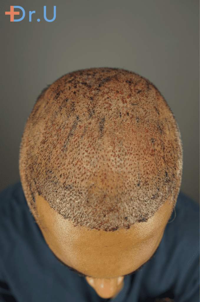 hairline restoration for a 29 years old male patient.