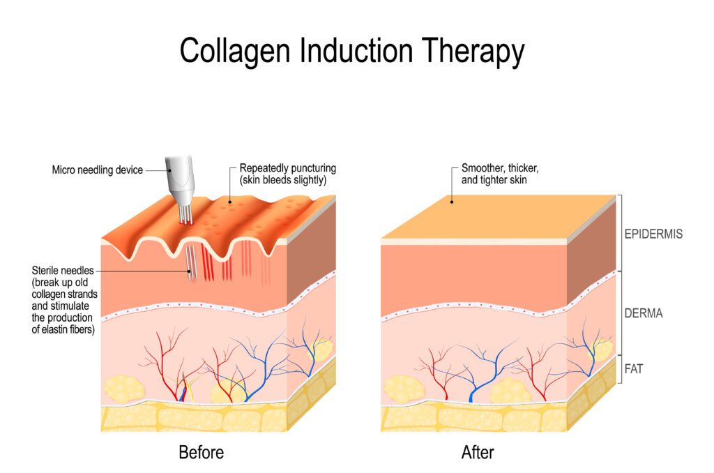 Collagen induction therapy (microneedling) is a surgical for remove wrinkles, scars, stretch, marks, pigmentation. skin needling procedure, repeatedly puncturing the skin with tiny, sterile needles (microneedling the skin). Collagen induction therapy (microneedling) is a surgical for remove wrinkles, scars, stretch, marks, pigmentation. skin needling procedure, repeatedly puncturing the skin with tiny, sterile needles (microneedling the skin).