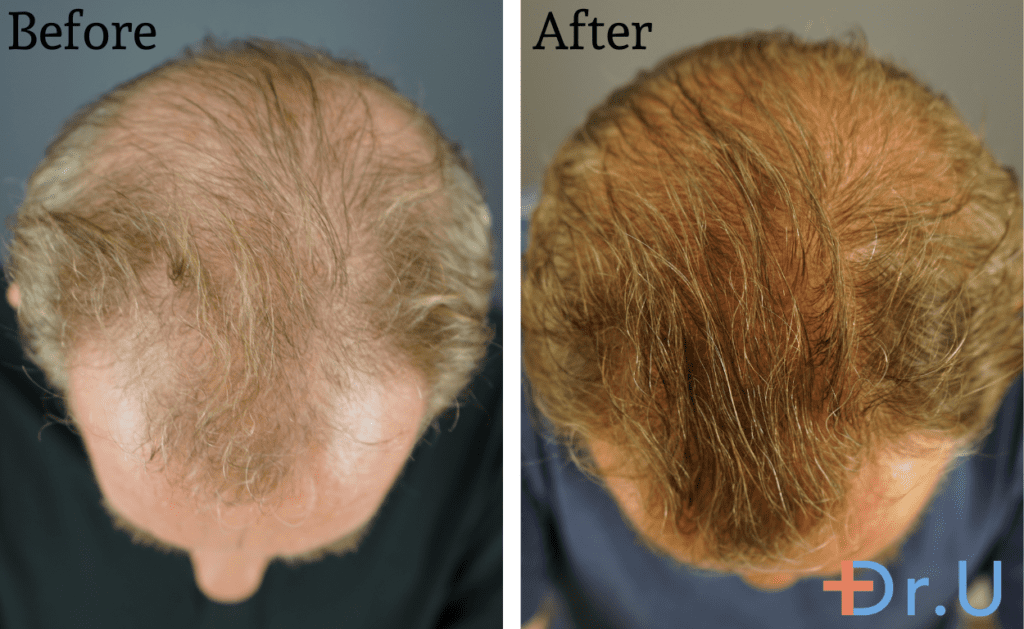 After consistently using Gashee products for 10 months, the patient saw significant natural hair growth. 
