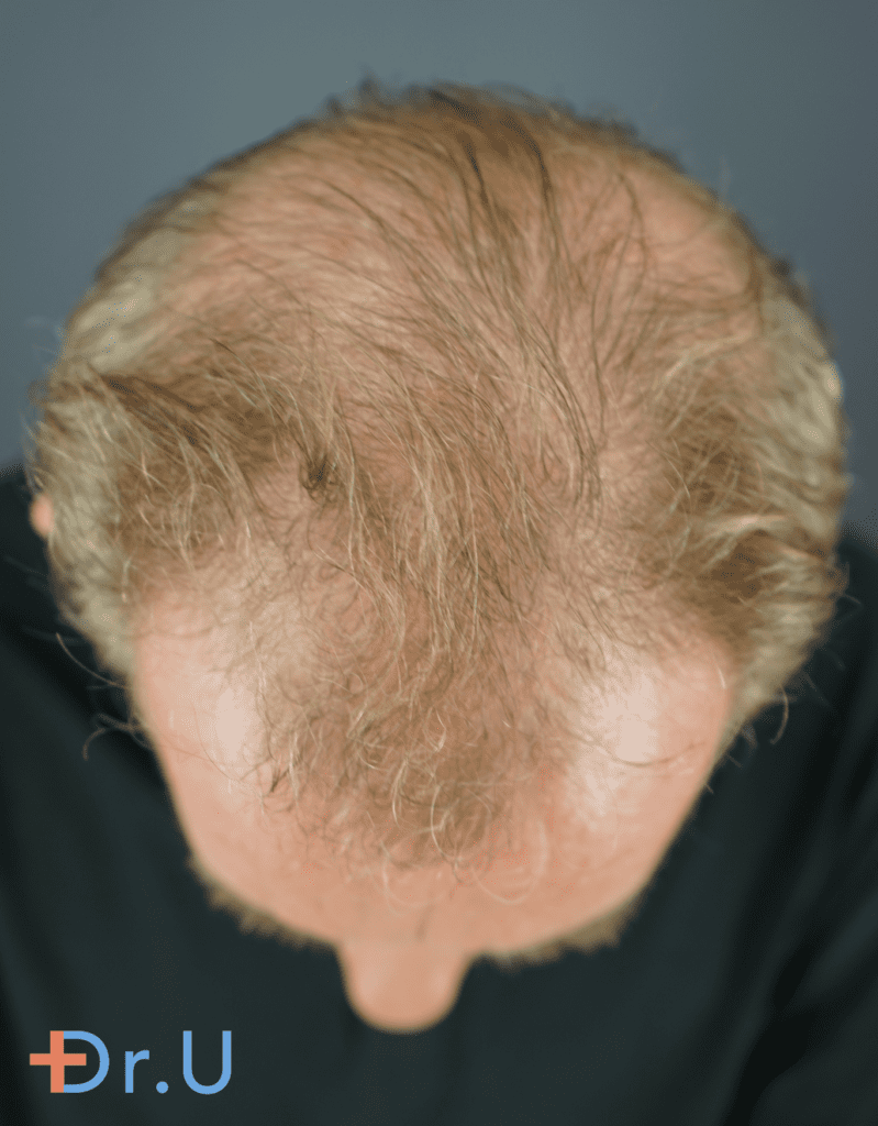 The patient suffered from hair loss and assumed his only solution was a hair transplant. 