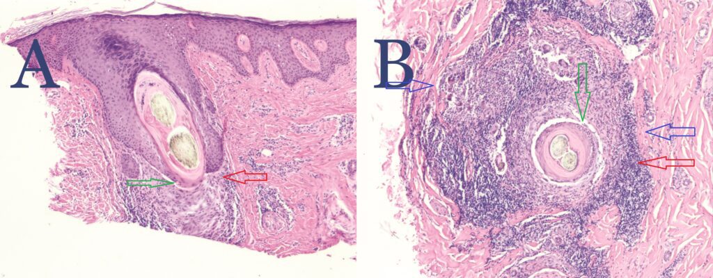 NAS biopsy showing PIILIF (A-vertical biopsy, B - horizontal biopsy). 