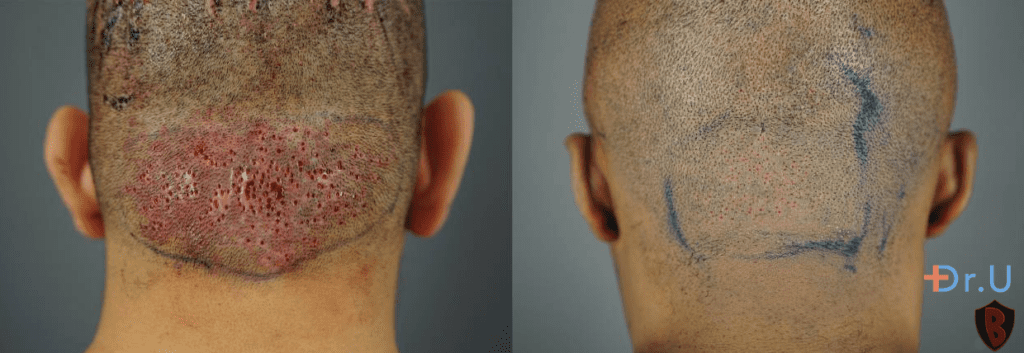 Hispanic male patient seen with tiny wounds secondary to FUE procedure, taken immediately after surgery for papular AKN (left). African male patient with tiny wounds secondary to FUE procedure, taken immediately after surgery for papular AKN (right). 