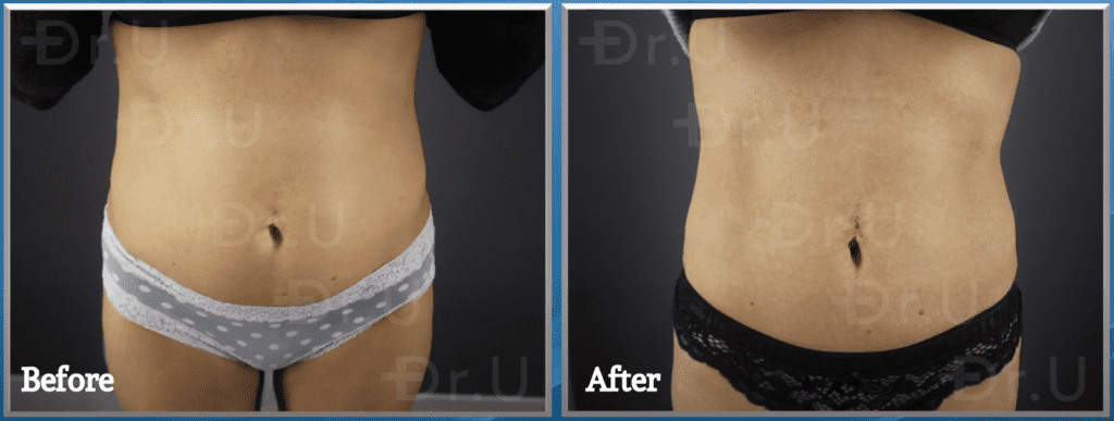 Emscupt treatment results. The patient was treated by Dr. Sanusi Umar at Dr. U Hair and Skin Clinic.