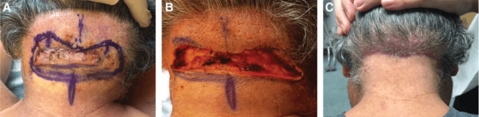 The patient had a large AKN lesion. (B) Immediately after the surgical removal of the lesion. (C) The patient 8 weeks post-procedure. The patient had a large AKN lesion. (B) Immediately after the surgical removal of the lesion. (C) The patient 8 weeks post-procedure.