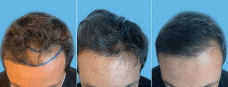 Unshaven FUE procedure allows individuals to continue on with their everyday lives without anyone noticing that they underwent a hair transplant procedure.