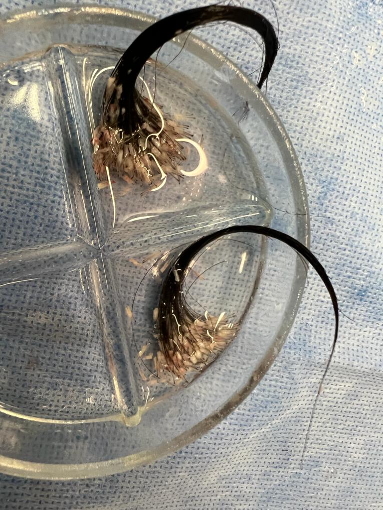 Long hair shafts extracted with the UGraft Zeus.