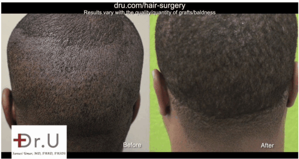 Back view comparison of African descent patient before and after FUE hair transplant with Dr. UGraft Zeus showing increased hair density and natural growth.