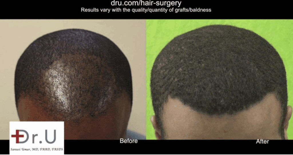 Comparison of an African descent patient before and after FUE hair transplant with Dr. UGraft Zeus showing restored hairline and fuller hair coverage.
