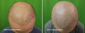 Before and after photos from above showing improved scalp coverage and hairline definition after scalp micropigmentation on a male patient.