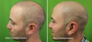 Side-by-side comparison of a male patient before and after scalp micropigmentation, showing natural-looking density and restored confidence.