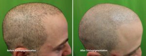 Side-by-side comparison of a male patient before and after scalp micropigmentation, showing natural-looking density and restored confidence.