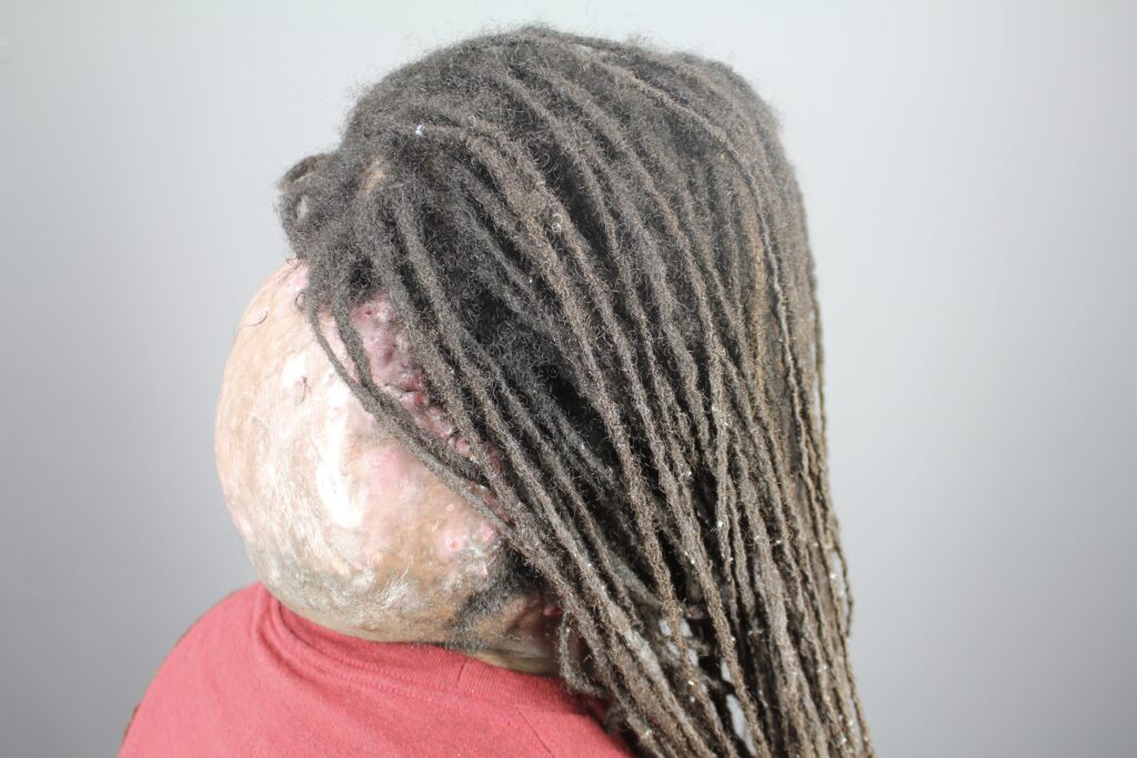 Side profile view of a patient’s neck showing a large AKN bump that was previously misdiagnosed and worsened by ineffective treatments.