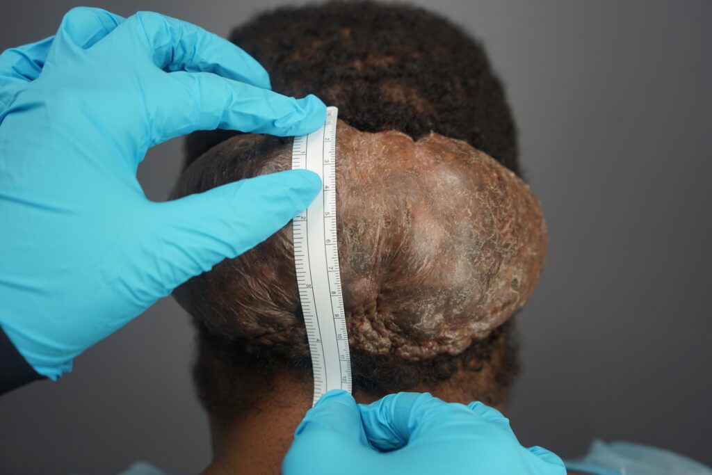 Measurement of Adrian’s large Acne Keloidalis Nuchae (AKN) located behind his head.