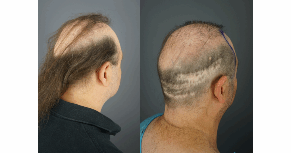 Jon remains in a state of extreme baldness (Norwood 7) even after multiple failed hair transplants. Visible scarring and an abnormal hair pattern reveal the effects of depleted scalp donor supply and poor graft placement from prior procedures.