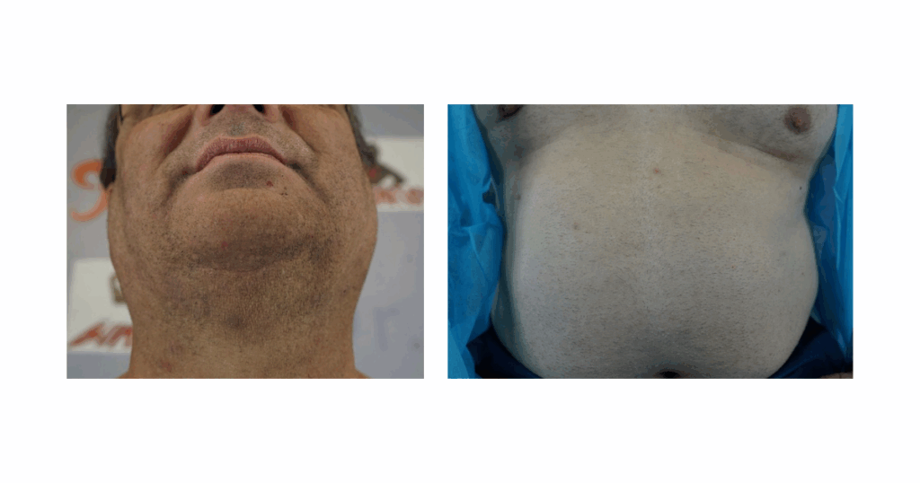 Jon’s beard and stomach areas fully healed after body hair extraction. Thanks to the UGraft Zeus system, both donor sites display minimal scarring following the procedure.
