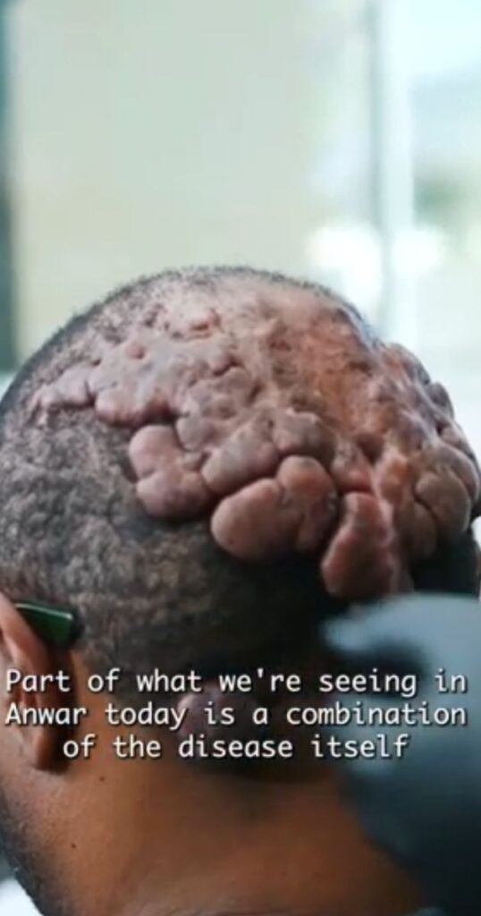 Dr. Sanusi Umar is examining Umar’s scalp. Anwar’s case is complicated by two distinct scalp conditions at work, Folliculitis Decalvans and Acne Keloidalis Nuchae.