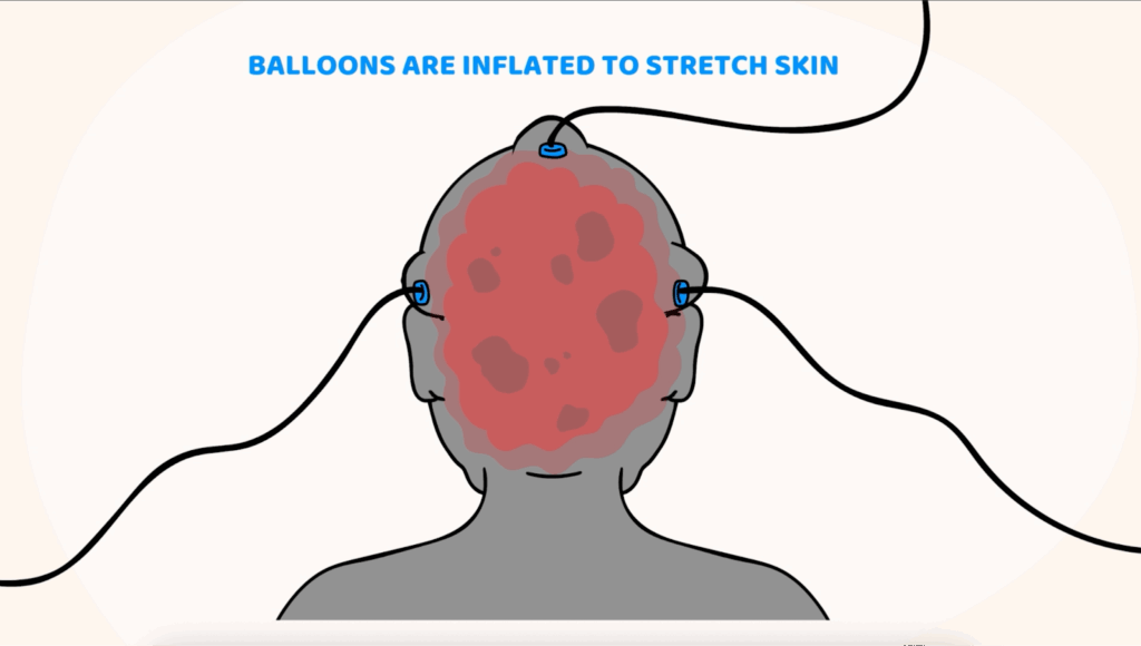 The illustration shows how the balloon expansion method stretches the skin around the scalp, which imposes a significant trauma to the patient’s scalp.
