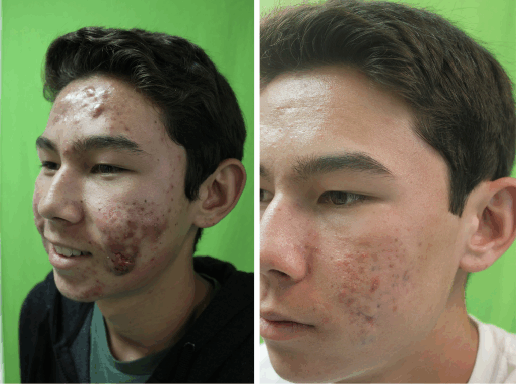 Michael’s skin went from severe breakouts to clearer and smoother with Dr. Umar’s laser treatments.