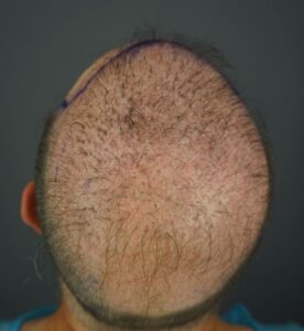 Top-down before-treatment image of advanced androgenetic alopecia with extensive scalp exposure, illustrating a severe baldness case discussed in relation to PIILIF.