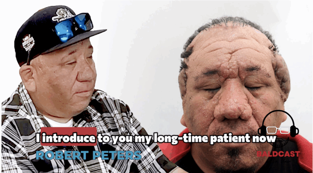 Dr. Sanusi Umar introduces one of his long-time patients and now a friend, Robert, who has a severe case of acne keloidalis nuchae