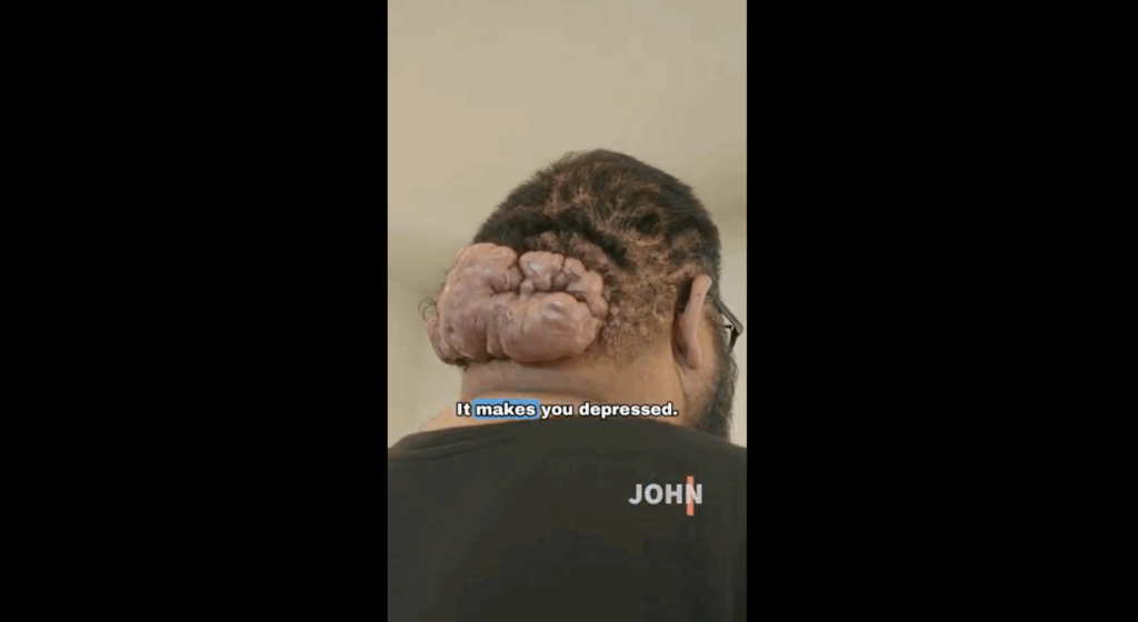 The severe, boil-like growths on John Picone's head, diagnosed by Dr. Sanusi Umar as a combination of three challenging scalp conditions.